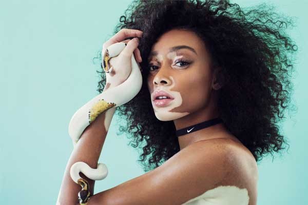 El vitiligo se caracteriza por la pérdida de la pigmentación en la piel. Winnie Harlow