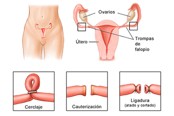 Se puede realizar después de un parto, aborto, durante la cesárea o en cualquier momento que la mujer decida no tener más hijos.
